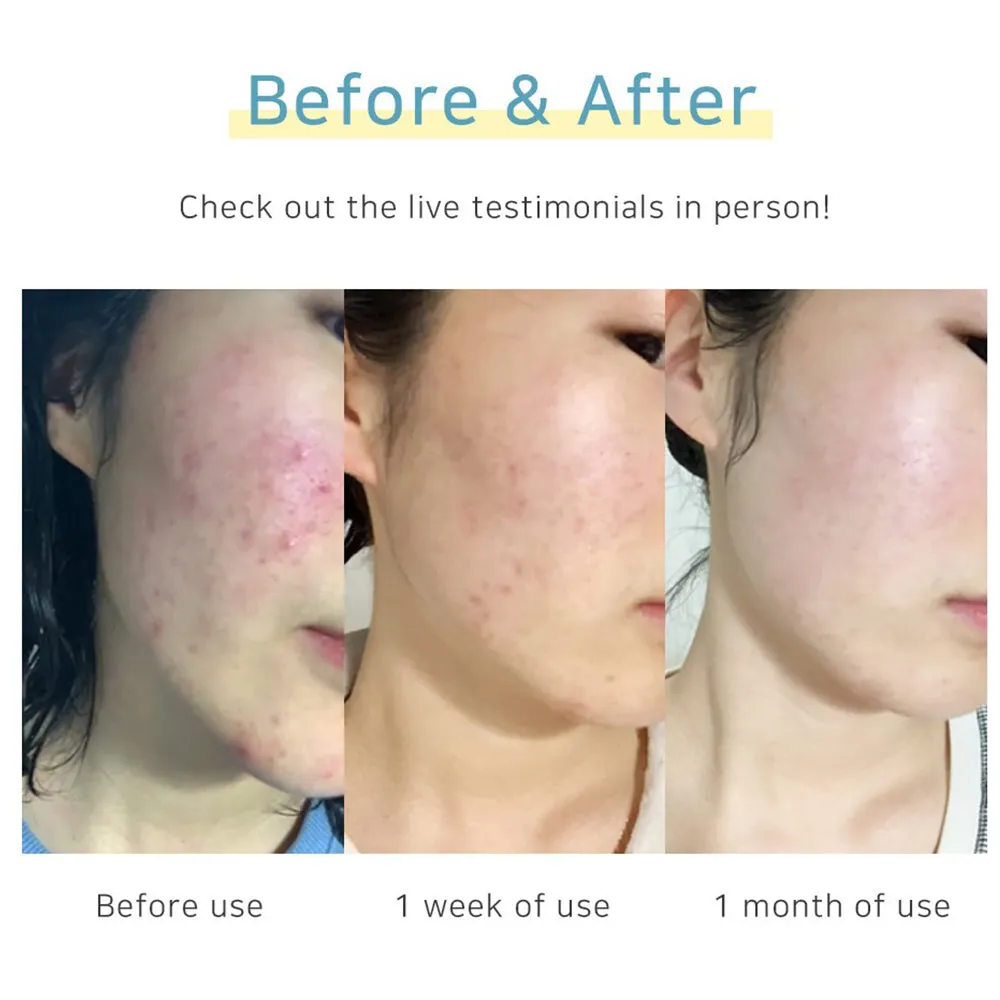 Blemish Aid Propolis  Cream